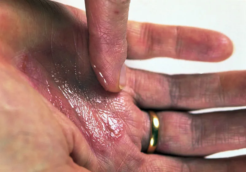 Photo of individual using ointment on the palm of their hand.