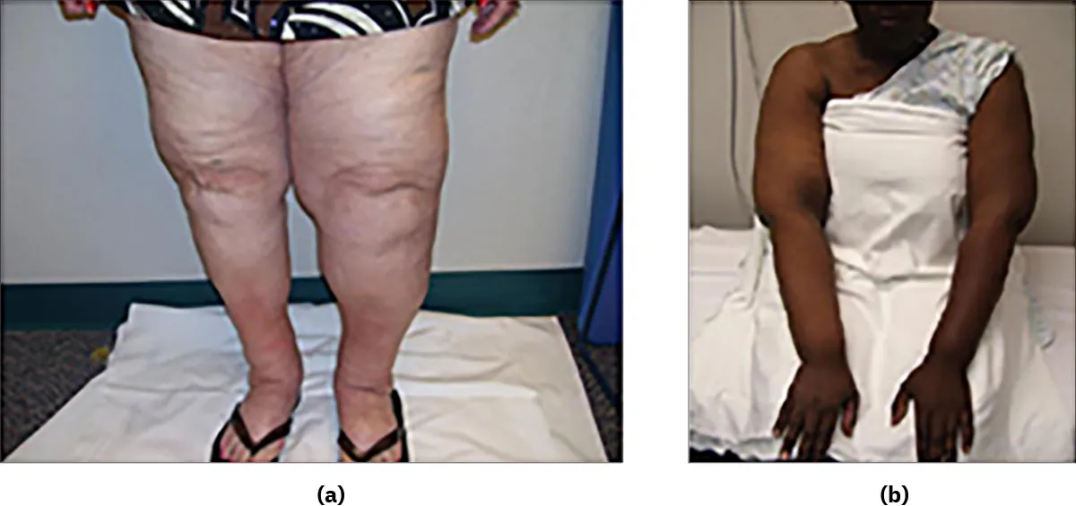 Two color photographs of women show (a) bilateral lower extremity lymphedema and (b) upper extremity lymphedema.