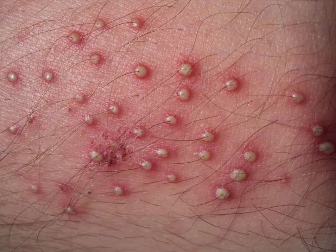 Photo of folliculitis on a body part.