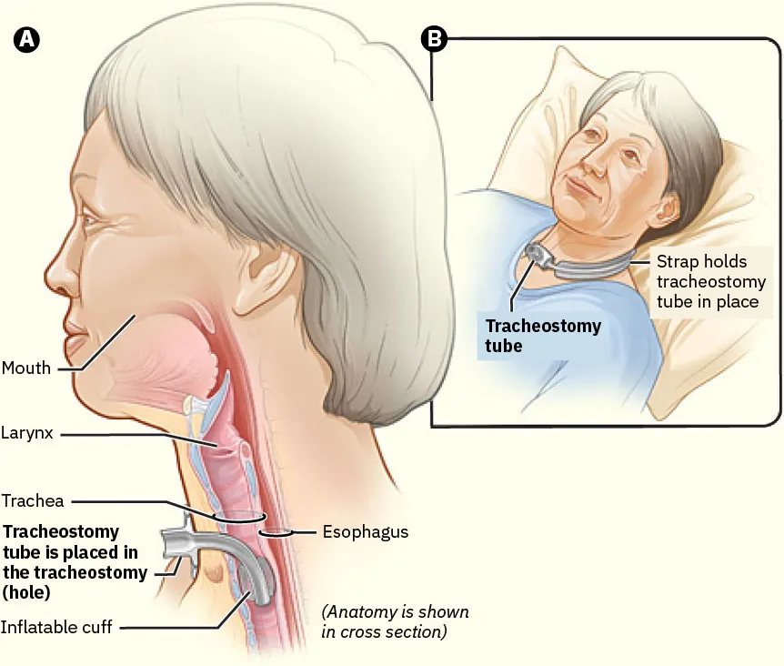 Panel A (left): A side view of a person’s head and neck shows the anatomical placement of a tracheostomy tube. The diagram labels the mouth, larynx, trachea, esophagus, and the tracheostomy tube, which is inserted into the tracheostomy (hole) in the trachea. An inflatable cuff around the tube helps to secure it in place. The anatomy is shown in cross-section, highlighting the internal positioning of the tube within the trachea. Panel B (right): An inset shows a patient lying on a pillow with a tracheostomy tube in place, held by a strap around the neck. This panel provides a contextual view of how the tracheostomy tube is used and secured in a real-life scenario.