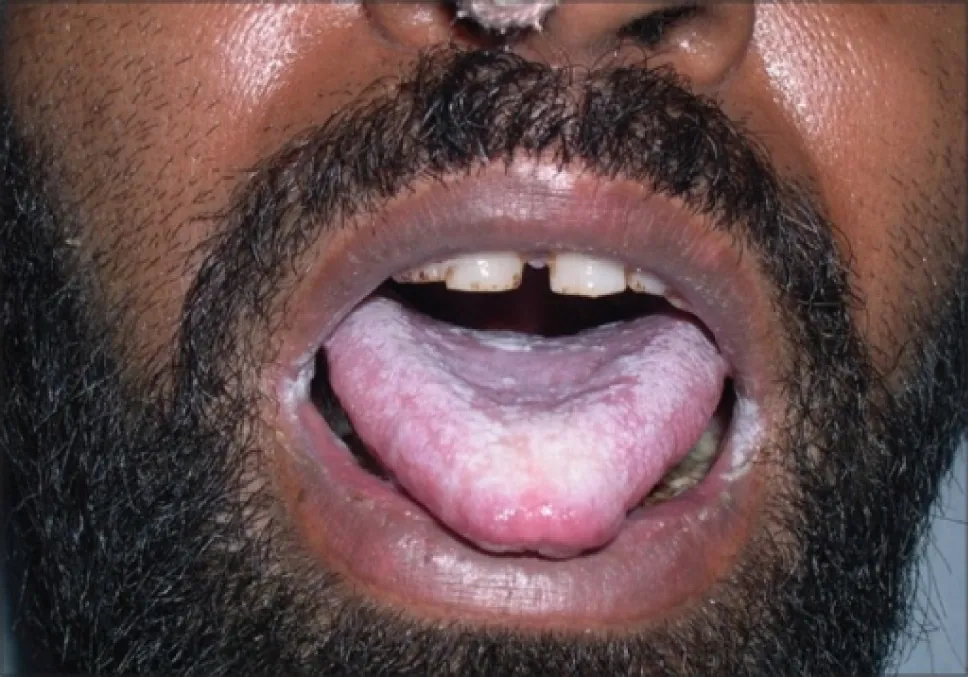 The image shows a close-up of a man's open mouth. The tongue appears coated with a thick white layer, indicative of oral thrush (candidiasis). The man has a full beard, and some of his teeth are missing or appear to be damaged.