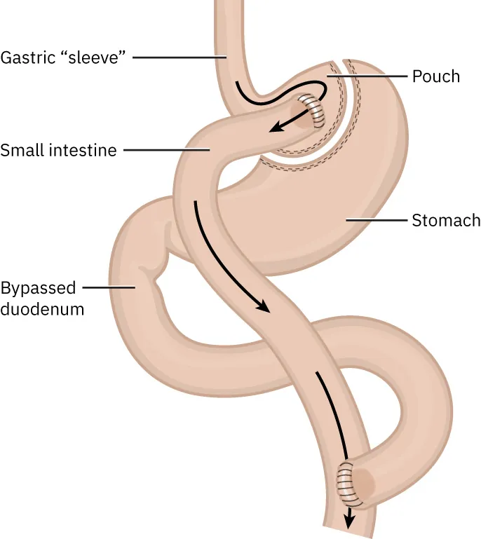Illustration of gastric bypass, with labels for Gastric "sleeve," Small intestine, Bypassed duodenum, Pouch, and Stomach.