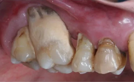 A photograph of teeth with seriously inflamed gums and exposed dental bone.