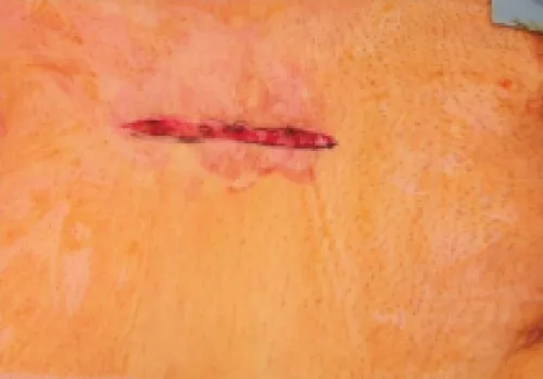 Example of an acute wound.