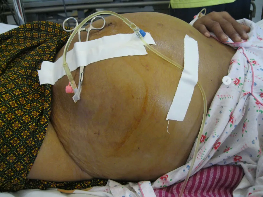 A patient with ascites