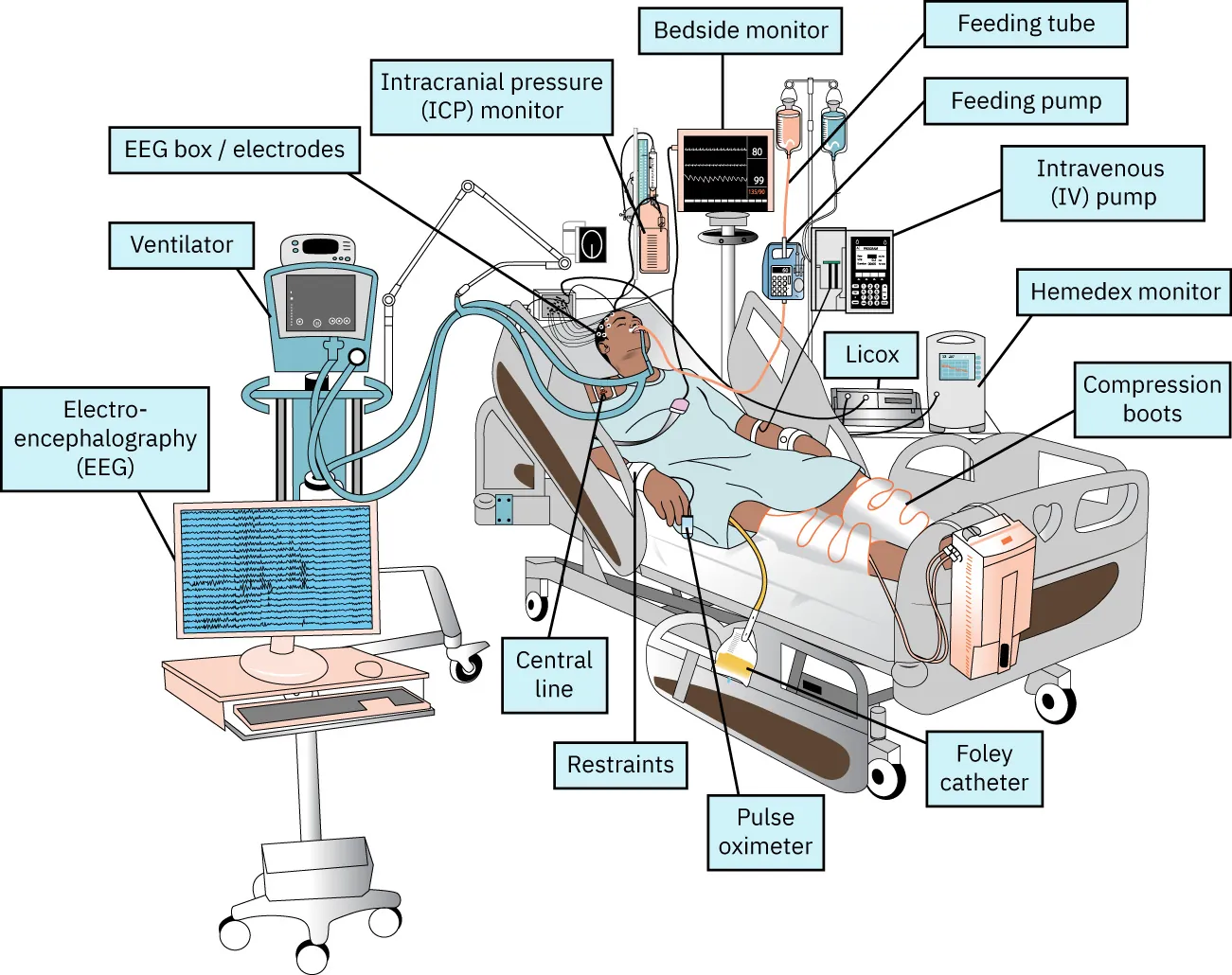 Diagram showing patient being treated for sepsis in critical care unit; labels show electroencephalography (EEG), ventilator, EEG box / electrodes, intracranial pressure (ICP) monitor, bedside monitor, feeding tube, feeding pump, intravenous (IV) pump, hemedex monitor, compression boots, licox, Central line, restraints, pulse oximeter, foley catheter