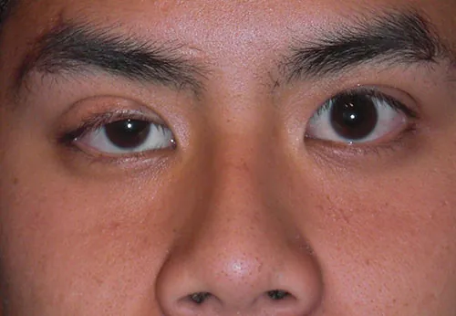 A photo of two eyes, one with a dropped eyelid, due to ptosis.