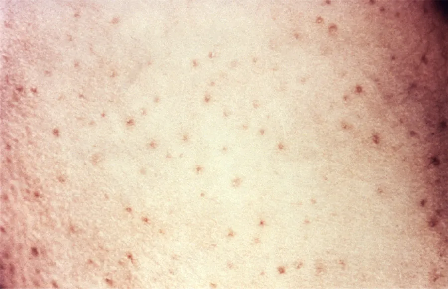 A close-up of skin shows numerous pinpoint spots.