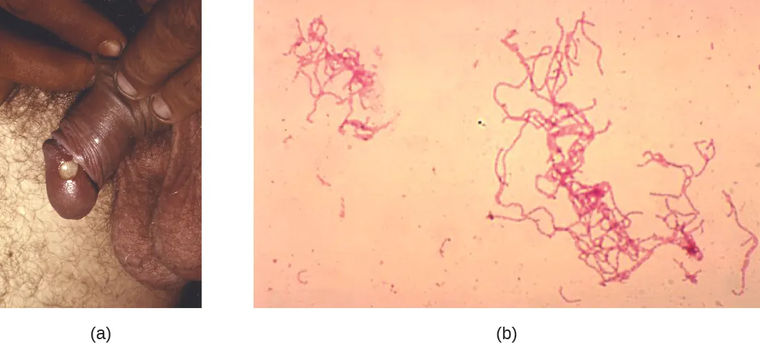 a) Awhite swelling on a penis. B) rod shaped pink cells.
