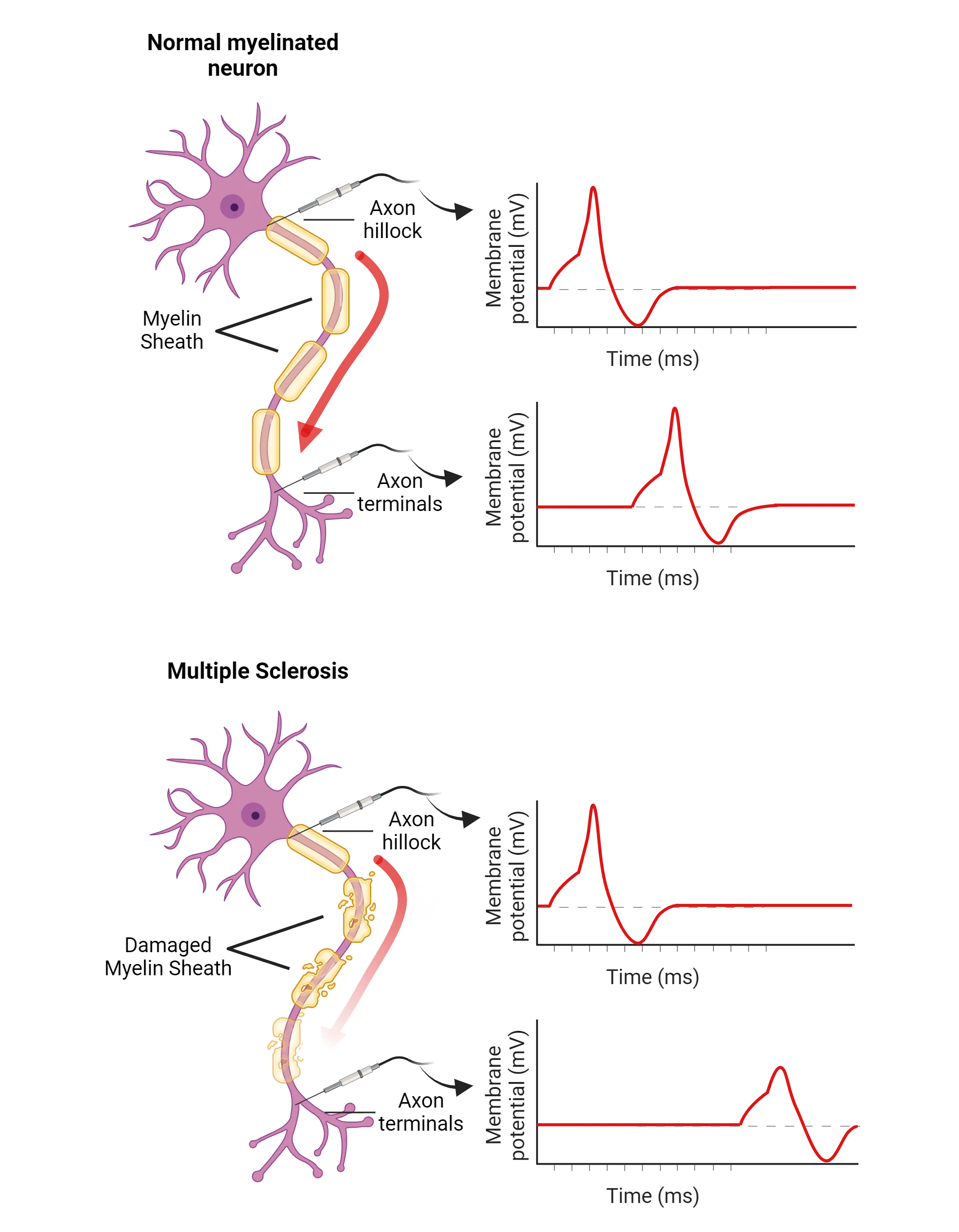 Top: Left: diagram of a neuron with a recording electrode, action potential traveling down the axon. Right: line graphs of action potential over time, showing earlier appearance at axon hillock and later near terminals. Bottom: Left: diagram of a neuron with a recording electrode, action potential traveling down the axon poorly due to degraded myelin. Right: line graphs of action potential over time, showing earlier appearance at axon hillock of normal action potential and much later appearance of degraded action potential near terminals. 