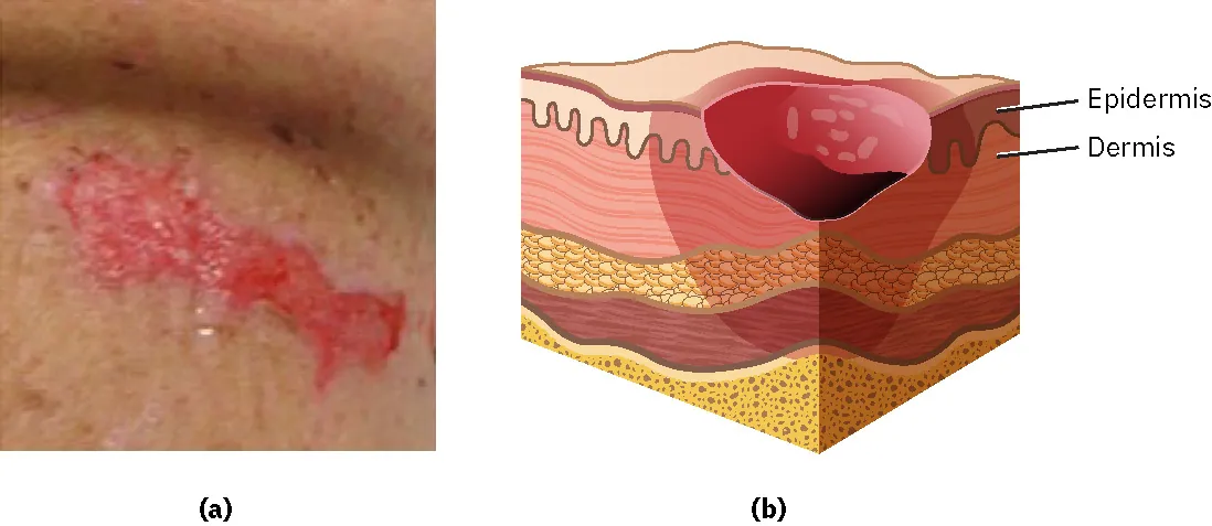 A photograph of a stage 2 pressure injury where there is loss of skin exposing the dermis. There is a diagram showing the same injury.