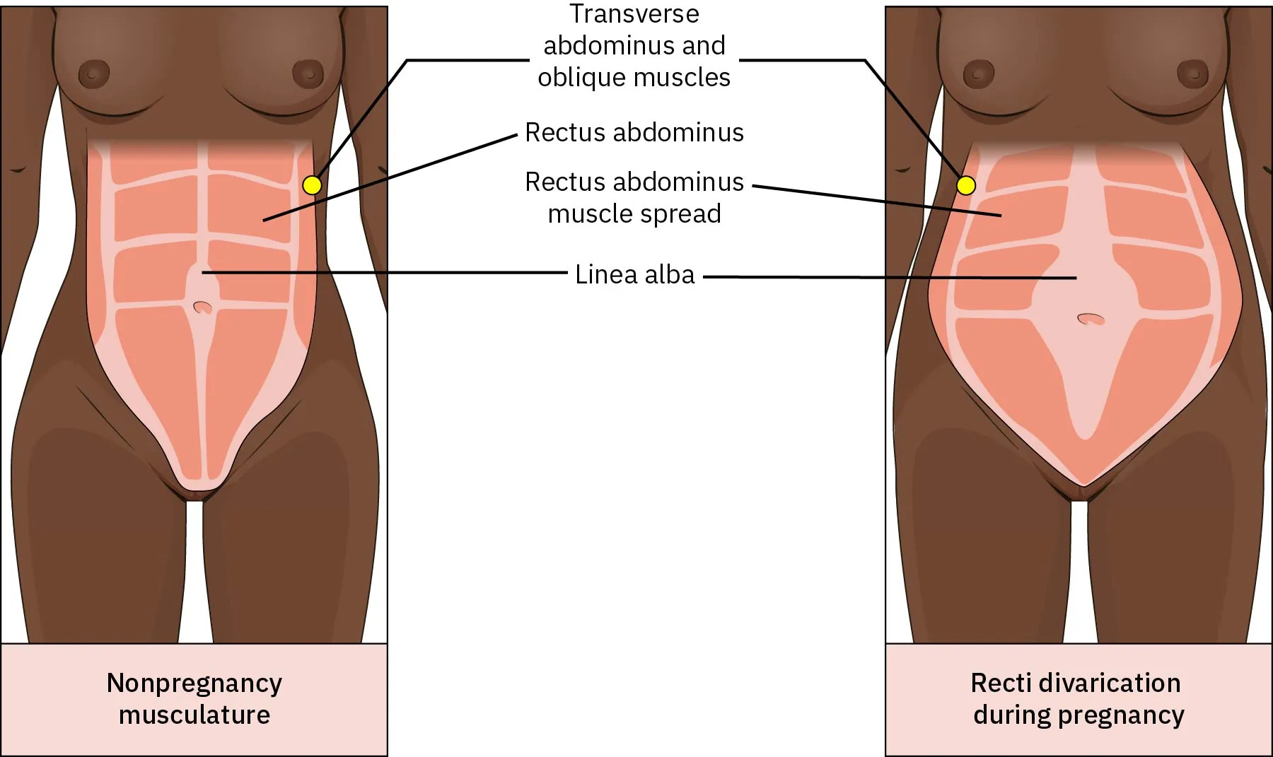 Rectus abdominis muscles and divarication