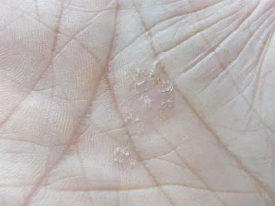 Photo of Pustular psoriasis on palm.