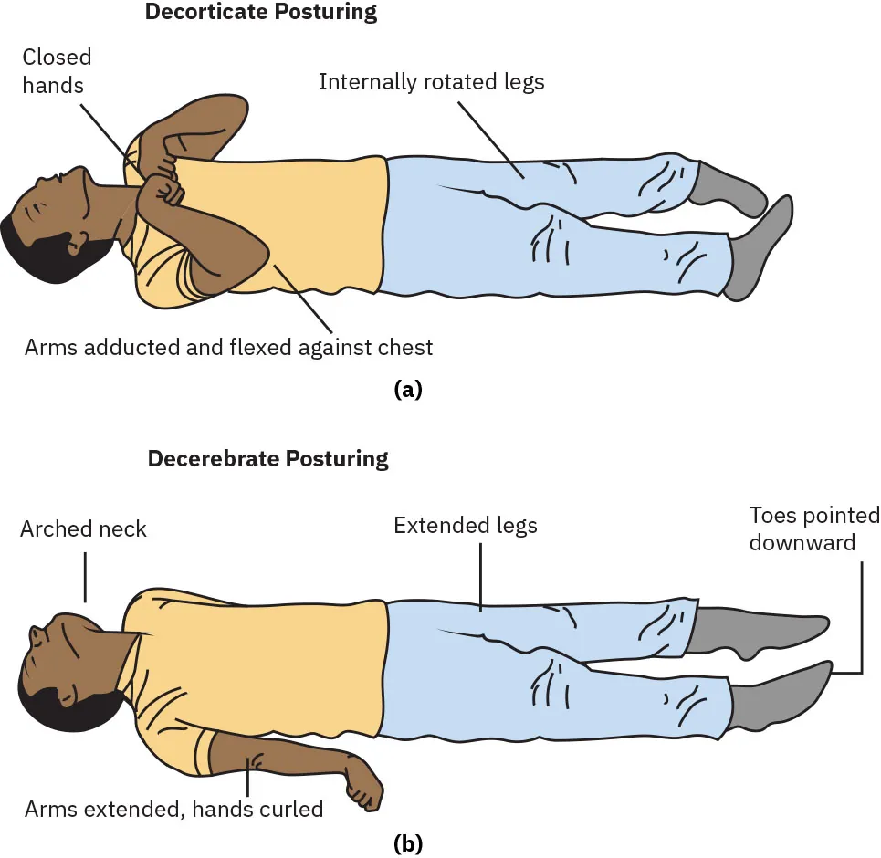 A labeled two-image illustration showing a man in a decorticate posture and decerebrate posture. While decorticate posturing, the man's hands are close, arms adducted and flexed against his chest, and legs internally rotated. While decerebrate posturing, the man's toes are pointed downward, legs are extended, and neck is arched.