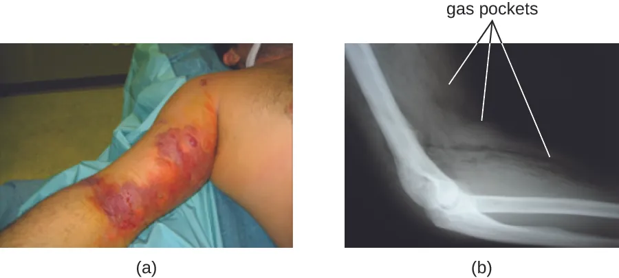 a) an arm with large purple and red regions. B) X-ray of an arm showing white muscles and cloudy skin. A dark black band cuts through the skin.