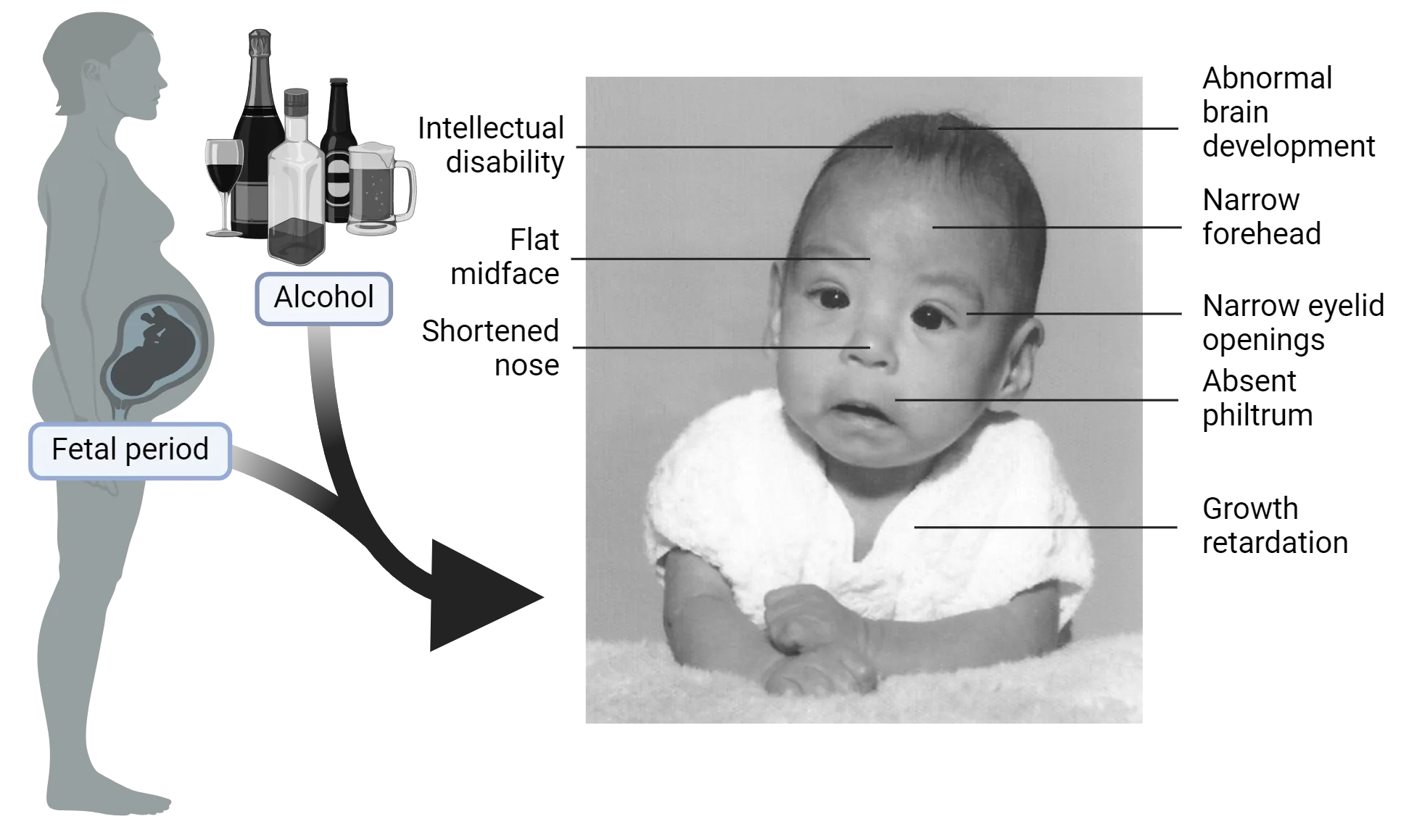  Left is a diagram showing a pregnant woman and alcoholic drinks. Left is a photo of a baby with FASD. Phenotypes noted are: intellectual disability, abnormal brain development, narrow forehead, flat midface, narrow eyelid openings, shortened nose, absent philtrum, growth retardation.