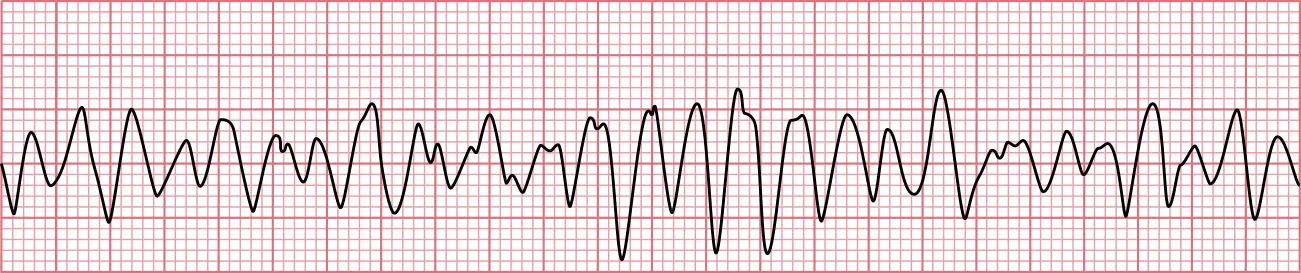 Sinus rhythm showing ventricular fibrillation with no pattern, fast rate, no discernable P waves, QRS waves not well captured, and variation in the morphologies of the QRS complex.