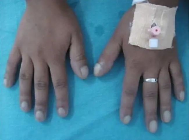 Hand showing clubbing in tips of fingers.