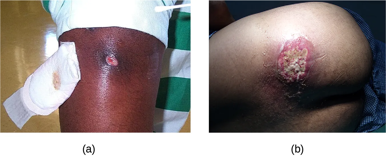 Superficial Staphylococcal Infections. Description below.