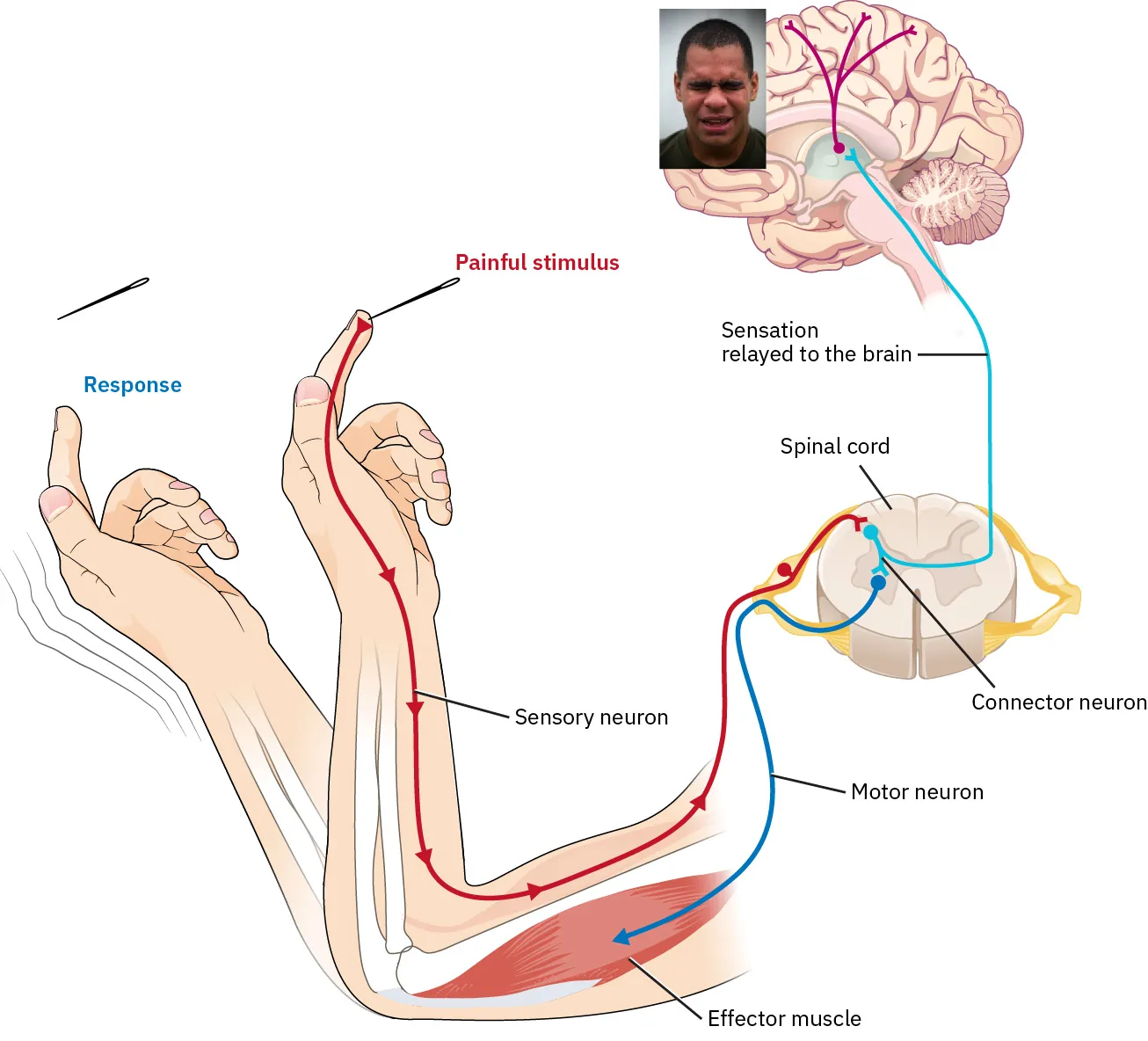 Illustration of painful stimulus in a finger traveling through sensory neurons, the spinal cord, connector neurons, then relayed to the brain. Motor neurons then stimulate effector muscles causing a response.
