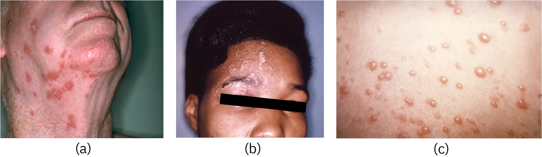 a) Large red spots on an adult&rsquo;s neck. b) Bumps on an adult's face. c) Red bumps on skin.