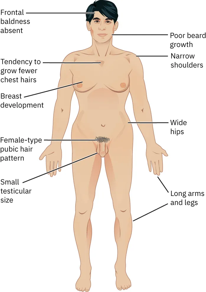 Image of person with Klinefelter syndrome displaying frontal baldness absent, poor beard growth, narrow shoulders, fewer chest hairs, breast development, wide hips, female-type pubic hair pattern, small testicular size, long arms/legs.