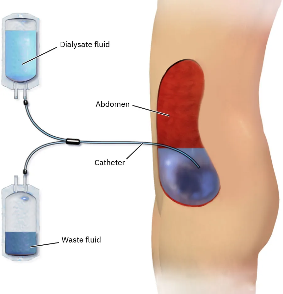 Peritoneal dialysis