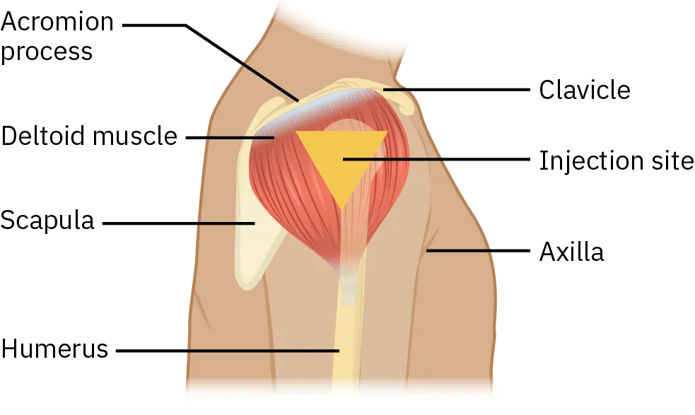 A diagram of the parts of a shoulder shows where the triangle of the injection site for a deltoid injection can be found. The acromion process is between the clavicle and top right of the scapula. The injection site is over the deltoid muscle slightly below the acromion process.