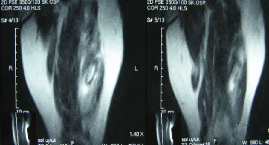 The image shows two MRI scans of a human muscle. The scans display cross-sectional views of the muscle tissue, revealing variations in density and structure. The left scan shows a distinct central area with differing intensities, possibly indicating different types of muscle tissue or the presence of a lesion. The right scan similarly shows muscle tissue with varying intensities, providing a detailed view of the internal muscle structure. Both images include MRI settings and scale markers on the sides, indicating the technical parameters used during the scanning process. The scans provide a clear depiction of the muscle’s internal composition.