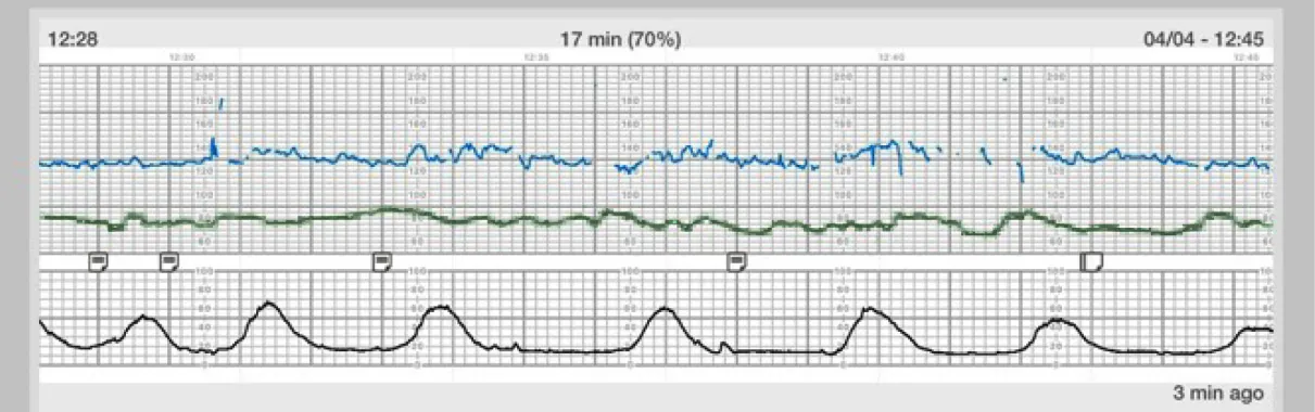 A tracing with the FHR in blue at the top. It ranges from 120 to 150 with occasional breaks in the line and occasional drops. The contraction tracing is at the bottom and has peaks that range from 50 to 70 from the baseline of approximately 10 and occur 2 to 3 minutes apart. FHR increases slightly at the peaks of contractions. A green line lies in the middle of the FHR and UC lines and ranges approximately from 70 to 90 with no apparent pattern.