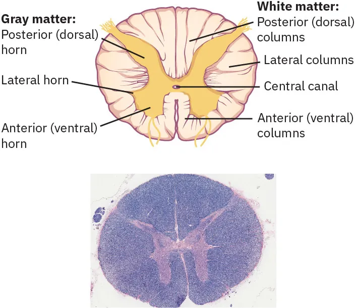 The image consists of two diagrams of a cross-section of the spinal cord. The top diagram is an anatomical illustration labeling the gray and white matter. The gray matter includes the posterior (dorsal) horn, lateral horn, and anterior (ventral) horn, shown in brown. The white matter includes the posterior (dorsal) columns, lateral columns, and anterior (ventral) columns, shown in yellow. The central canal, a small circular space in the center, is also labeled. The bottom diagram is a microscopic image of the spinal cord cross-section stained to show the structures, with the gray matter appearing in darker shades and the white matter in lighter shades, mirroring the labeled structures in the top diagram.