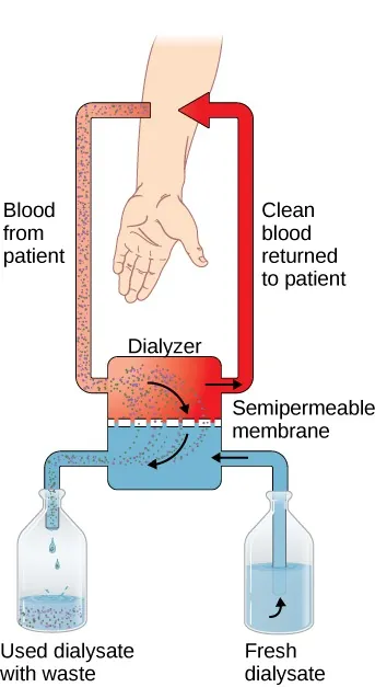 A diagram shows a patient’s arm, with an arrow representing blood leading from the arm to a dialyzer. In the dialyzer, the waste in the blood is drawn through a semipermeable membrane toward a compartment filled with fresh dialysate. The used dialysate then flows to a collecting bottle. The clean blood is returned to the patient’s same arm.