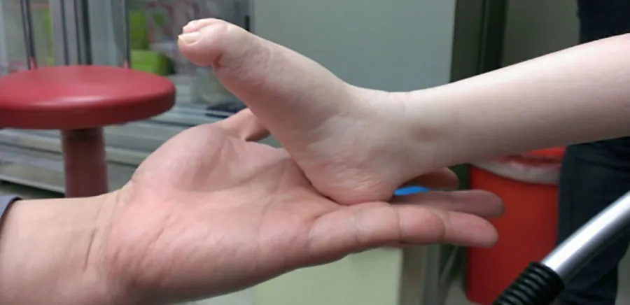 The image shows a close-up of a child’s foot being held by an adult’s hand. The child’s foot is slightly deformed, with an elevated arch and toes pointing downward, a condition indicative of a possible neuromuscular disorder. The adult’s hand is gently supporting the child’s foot. In the background, a red stool and various medical equipment can be seen, suggesting a clinical setting. The focus is on the interaction between the adult and child, highlighting the physical characteristics of the child’s foot.
