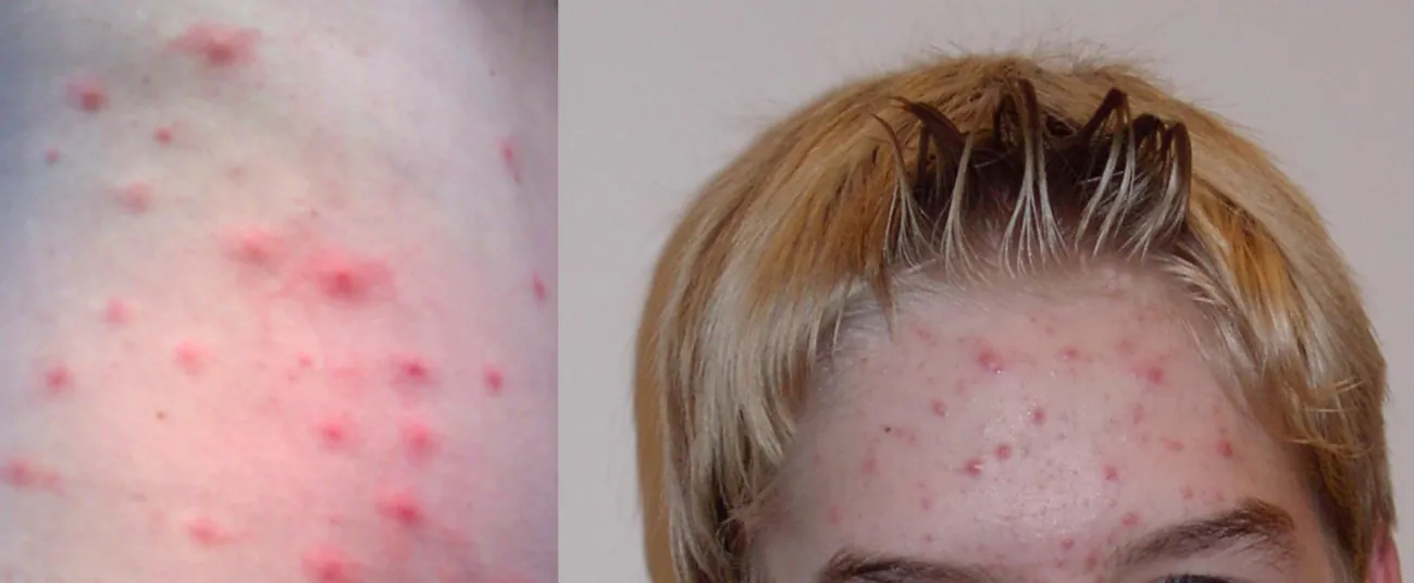 A person with acne on their forehead; also a close-up.