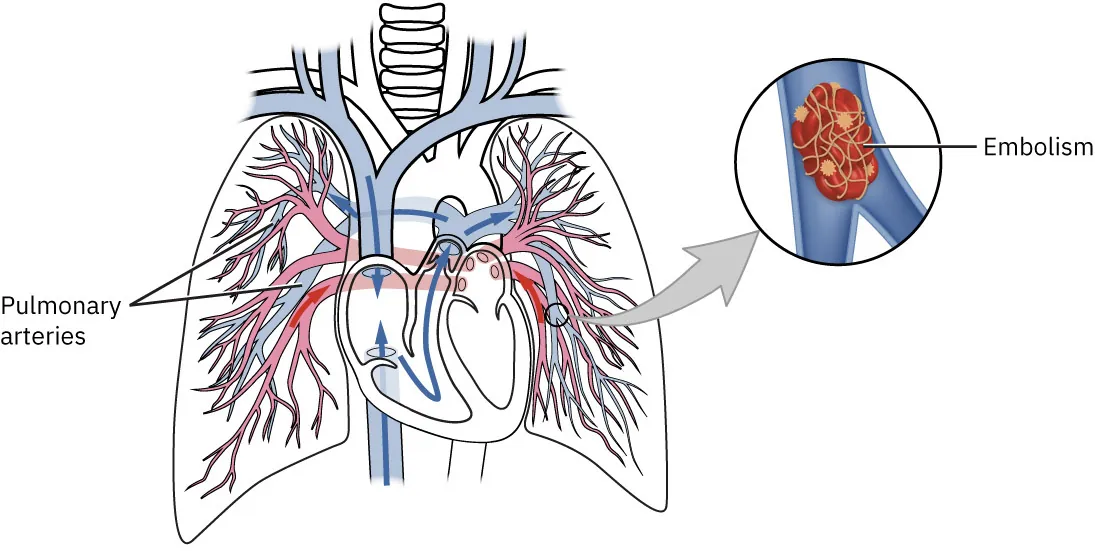 A diagram illustrates the veins and arteries in the human heart and lungs, highlighting the pulmonary arteries and an embolism.