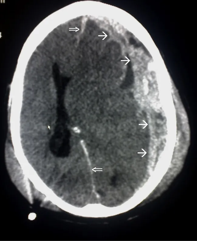 A CT image showing a midline shift due to a hematoma.