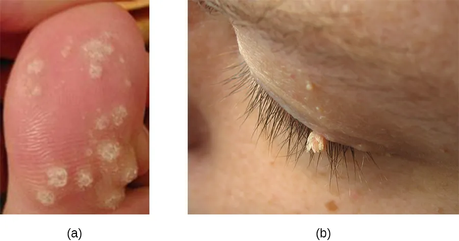 Warts on a toe wart on an eye.