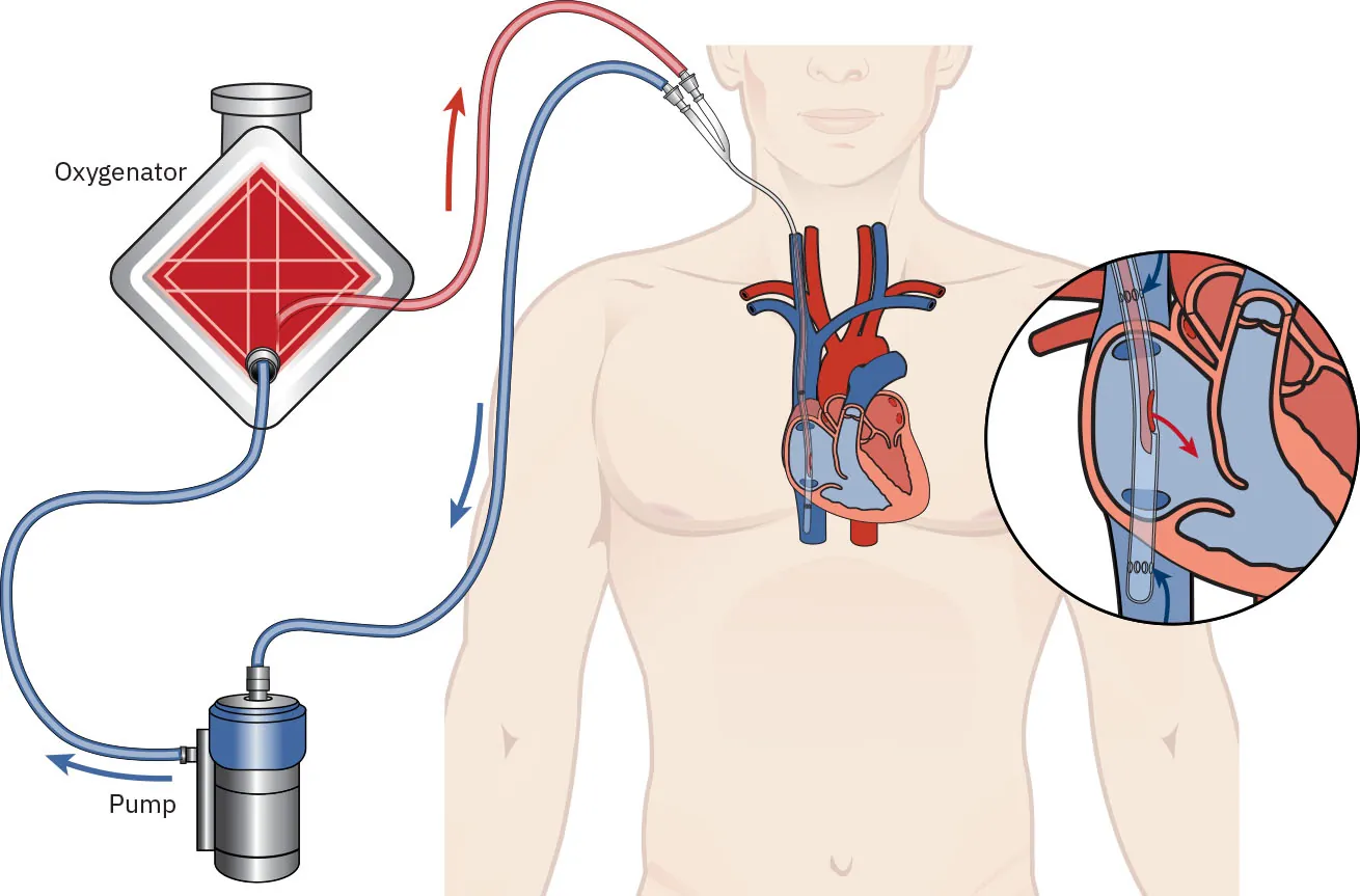 A color illustration showing an attached extracorporeal membrane oxygenation device. The oxygenator is connected to the catheter and the pump. There is a zoomed in image of the heart showing oxygenation entering the heart chamber.