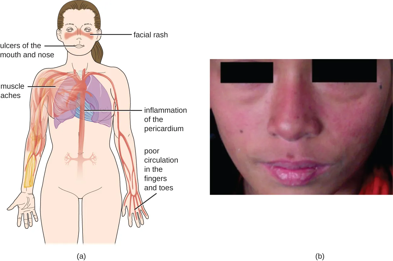 SLE symptoms. Description below.