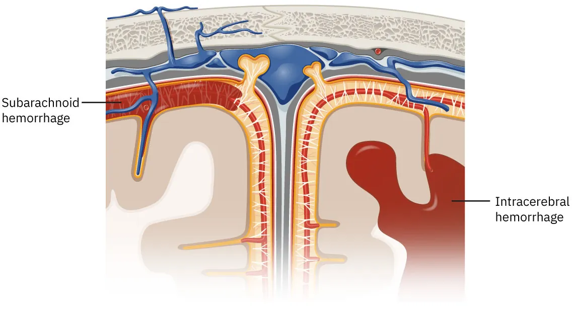 A diagram of a hemorrhagic stroke, labeling Subarachnoid hemorrhage and Intracerebral hemorrhage.