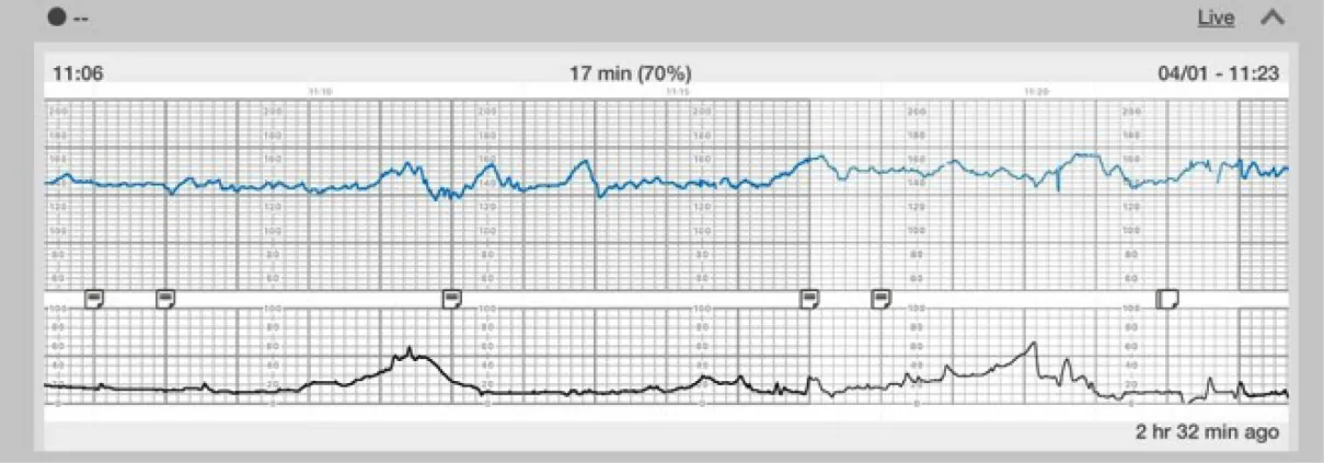The image shows a fetal monitor strip with two graphs. The top graph has an orange line indicating fetal heart rate, which appears steady with occasional fluctuations. The bottom graph has a white line displaying uterine contractions with a clear pattern of rising and falling activity. Both graphs are against a dark background with grid lines, and time stamps are present at the top and bottom edges.