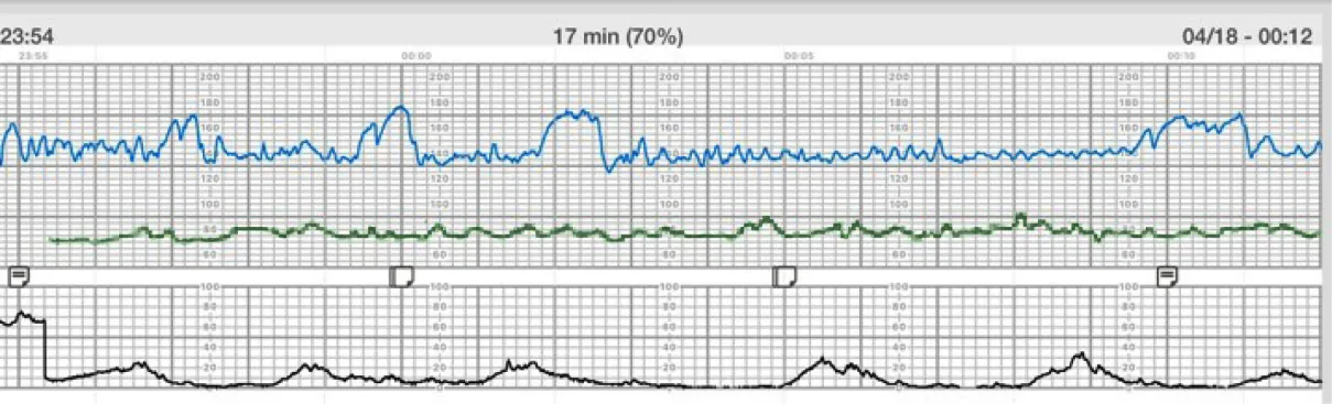 A screenshot of a fetal heart rate and contraction monitor with three separate graph panels. The top panel shows an orange line tracking fetal heart rate over time, with readings oscillating above and below 120 bpm against a dark background. The middle panel has a purple line displaying relatively flat uterine activity. The bottom panel depicts the intensity of contractions as white mountain-like peaks against a black background. Time stamps at the top right indicate the tracing spans from 23:54 to 00:12.