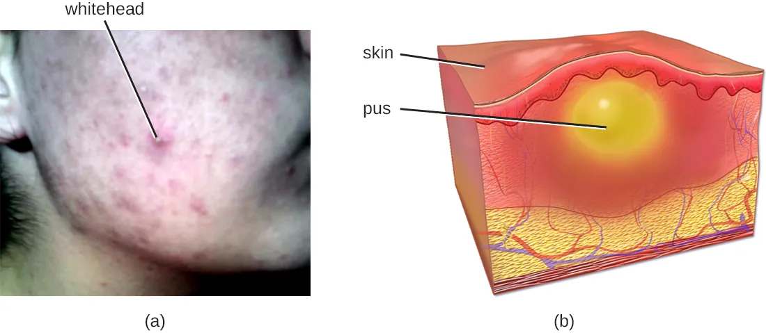 a) Acne (labeled whitehead) on a person&rsquo;s cheek. B) A drawing of skin with a yellow bubble labeled pus. This is below a raised region on the skin.
