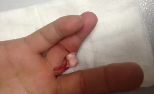 Example of an unintentional wound – open dislocation of a finger.