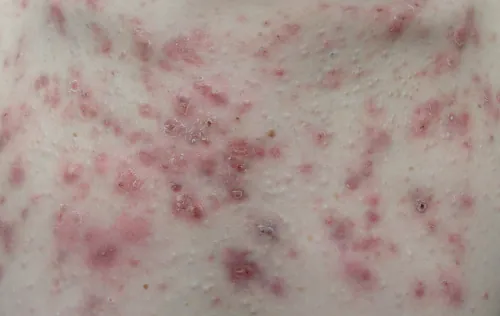 A color photograph showing acne vulgaris