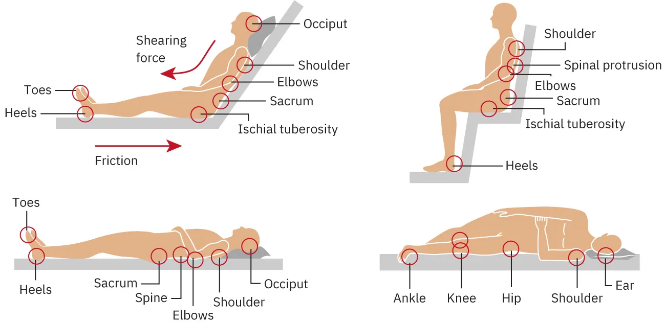 A four-panel diagram showing risk areas for pressure injuries. In the first panel the person is shown in a sitting position with the feet up. Areas of risk in this position include occiput, shoulder, elbows, sacrum, ischial tuberosity, toes, and heels. The second panel shows the person in a sitting position with the legs down. Areas of risk in this position include shoulder, spinal protrusion, elbows, sacrum, ischial tuberosity, and heels. The third panel shows the person lying down on the back. Areas of risk in this position include toes, heels, sacrum, spine, elbows, shoulder, and occiput. The fourth panel shows the person lying down on the side. Areas of risk in this position includes ankle, knee, hip, shoulder, and ear.