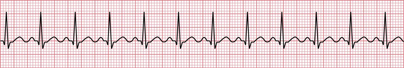 Sinus rhythm showing sinus tachycardia.