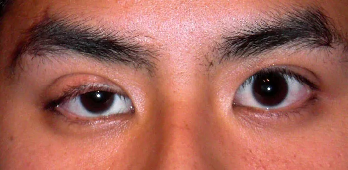 The image is a close-up of a person’s eyes, showing a condition known as ptosis. The person’s right eyelid (on the left side of the image) is drooping significantly compared to the left eyelid. Both eyes are open and looking forward, with the difference in eyelid position clearly visible. The person’s eyebrows and the skin around the eyes are also shown, providing context for the drooping eyelid. This condition, ptosis, can result from various underlying causes, including muscle weakness or nerve damage.