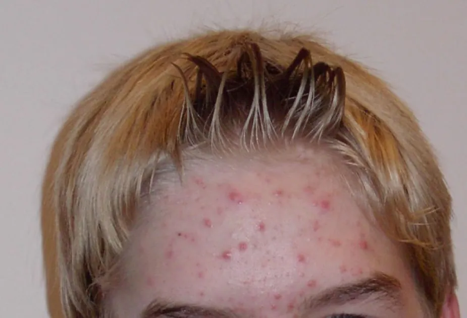 Photo of acne on a forehead.