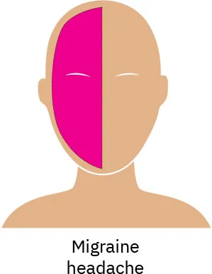 A drawing of a person’s face with a pink highlight on one side of the face, showing where pain caused by migraine is reflected.